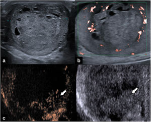 Paciente de 38 años con aumento de tamaño del escroto izquierdo. (a) Se observa una masa heterogénea testicular izquierda con componente quístico, (b) sin clara vascularización mediante el modo Doppler SMI. (c) La CEUS muestra un realce heterogéneo en una parte periférica del tumor (flechas) y ausencia de realce en otra parte; hallazgos que sugieren un tumor testicular con una extensa área necrótica. El diagnóstico final tras la orquiectomía fue de carcinoma embrionario con necrosis masiva.