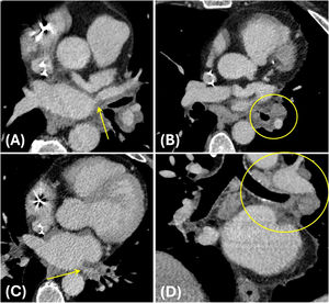 Estenosis venosa pulmonar con congestión secundaria. Varón de 57 años tratado previamente mediante ablación de venas pulmonares. Varios meses tras el procedimiento desarrolla estenosis de las venas pulmonares superior (flecha en A) e inferior (flecha en C) izquierdas. Asocia engrosamiento peribroncovascular y adenopatías a nivel del hilio izquierdo (círculos en B, D), secundario a la congestión de dicho pulmón.