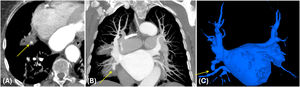 Trombosis venosa pulmonar. Varón de 69años, 4meses tras el tratamiento ablativo de venas pulmonares. Las TC de control (A, B) y la reconstrucción 3D (C) muestran defecto de opacificación de la vena pulmonar inferior derecha consistente con trombosis (flecha amarilla).