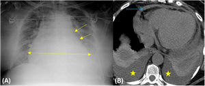 Taponamiento cardiaco. Mujer de 66años tratada con ARVP. Radiografía simple de tórax (A) realizada inmediatamente tras el procedimiento (descrito como complicado y no exitoso). Ensanchamiento de la silueta cardiaca (flecha con doble punta en A) y aplanamiento del borde de la ventana aortopulmonar (flechas con una sola punta en A) en relación con derrame pericárdico grave y clínica de taponamiento, realizándose pericardiocentesis urgente. La TC de control (B) muestra leve derrame pericárdico (flecha azul en B) y moderado derrame pleural bilateral (estrellas amarillas en B).