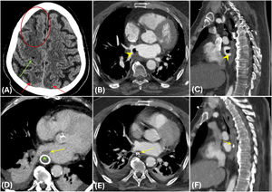 Fístula atrioesofágica. Varón de 72años, 1mes tras la ablación de venas pulmonares. Sospecha de ictus secundario al procedimiento. La TC de cráneo basal (A) muestra pérdida de la diferenciación sustancia gris-blanca en territorio frontera consistente con isquemia (círculo y flechas rojas en A). Burbuja de gas (flecha verde en A) en el parénquima afecto en relación con embolismo gaseoso (más burbujas no incluidas en la imagen). La TC de tórax (B y C) muestra defecto de opacificación focal con gas en la pared posterior de la aurícula izquierda adyacente al esófago (flecha amarilla en B y C), compatible con fistula atrioesofágica. El mismo paciente fue tratado de forma urgente con implantación de endoprótesis esofágica (estrella verde en D). Tras el tratamiento persiste componente de trombo adyacente al punto de fístula previamente presente (flecha en D). Un mes después (E y F) se retiró la prótesis (sin evidencia de fuga durante el procedimiento), dejándose algunos clips en su lugar (flecha en E y F) por la presencia de una pequeña úlcera mucosa secundaria al decúbito de la prótesis.