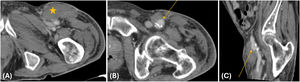 Complicaciones relacionadas con el acceso vascular. Hematoma (estrella en A) en la región del acceso vascular (arteria femoral común izquierda) en contexto de formación de un pseudoaneurisma (flecha en B y C) secundaria a la punción vascular.