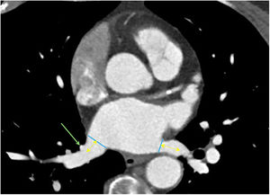 Medidas de interés en la planificación para el procedimiento ablativo de venas pulmonares: diámetro del ostium venoso (líneas azules) y longitud del tronco venoso pulmonar (flechas amarillas). Se referencia la rama de primer orden de la vena lobar inferior derecha (flecha verde).