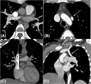 Ejemplos de DVPAP supracardiaco. DVPAP del LSD a la vena cava superior (flecha azul en A,C) y del LSI a la vena innominada (flecha amarilla en B,D).