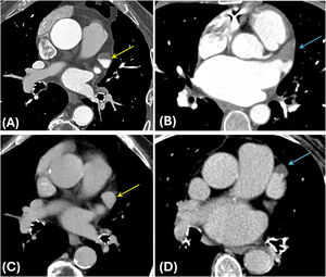 Evaluación de posible trombosis en orejuela izquierda en estudios de planificación pre-ablación de venas pulmonares. Defecto de llenado con margen lineal en región antideclive de la orejuela izquierda (flecha amarilla en A). En fase tardía (C) se observa completa opacificación de la orejuela descartando trombosis (flecha amarilla en C). Defecto de opacificación en región antideclive de la orejuela izquierda (flecha azul en B), con persistencia de componente no opacificado en fase tardía (flecha azul en D) compatible con trombosis.