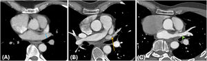 Estenosis venosa pulmonar. Varón de 64 años. Estudio TC pre-ablación (A), con diámetro normal del ostium (línea azul en A). TC de control 1mes tras el procedimiento (B): estenosis focal cerca del ostium de la vena pulmonar superior izquierda (flecha amarilla en B). La TC después del tratamiento (C) con realización de angioplastia e implantación de stent muestra adecuada normalización del calibre vascular (punta de flecha verde en C).