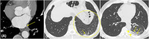 Estenosis crítica venosa pulmonar con congestión e infarto pulmonar secundario. Varón de 75 años con antecedente de ablación en dos ocasiones de venas pulmonares (hace 5 y 3 años). Estenosis grave del origen de la vena lobar inferior izquierda (flecha en A). Engrosamiento difuso de septos interlobulillares en LII (área señalada en B) y derrame pleural (puntas de flecha en C) con consolidaciones periféricas con contacto pleural compatibles con infartos pulmonares (flechas en B y C).