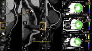 Paciente con factores de riesgo cardiovascular y riesgo intermedio de padecer cardiopatía isquémica. A)Reconstrucción planar curva de la arteria circunfleja (CX). B)Reconstrucción planar curva de la arteria CD, de la arteria posterolateral. La CTC muestra estenosis del 70-99% en el segmento proximal de la arteria CX (A1 y A2, placa mixta calcificada y no calcificada, flecha coloreada) y una estenosis del 50-69% en la arteria posterolateral (B1 y B2, placa mixta calcificada y no calcificada, flecha vacía). Un vaso mostraba cantidad severa de placa (P3). La TCP fue positiva para isquemia (I+), mostrando valores bajos de medidas de ROI en los segmentos anterolateral medio (C), los segmentos anterior, anterolateral e inferoseptal medios (D) y el segmento lateral apical (E), indicando isquemia sobre todo en el territorio de la CX (puntas de flecha y recuadros). El paciente fue clasificado como CAD-RADS 4A/P3/I+. Los hallazgos fueron corroborados en la coronariografía convencional posteriormente realizada (no se muestra).
