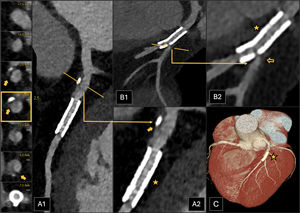 Paciente que acude para revisión tras colocación de stent. A)Reconstrucción planar curva de la arteria DA. B)Reconstrucción planar de la arteria DA, de la segunda rama diagonal. Se observa el stent (S) permeable en el segmento medio de la ADA (asterisco). También se objetiva estenosis de <25% en el segmento proximal de la DA (A1 y A2, placa mixta calcificada y no calcificada, flecha coloreada) y del 25-49% (CAD-RADS 2) en el origen de la segunda rama diagonal (B1 y B2, placa no calcificada, flecha vacía). Por lo tanto, al menos un segmento presentaba leve cantidad de placa coronaria (P1). Se muestra la reconstrucción volumétrica del corazón y de las arterias coronarias (C). El paciente fue clasificado como CAD-RADS 2/P1/S.