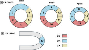 A)En el eje corto del ventrículo izquierdo de la CTC se muestra la división en 16 segmentos (basal, medio y apical). B)El eje largo muestra el ápex (segmento 17). La arteria coronaria descendente anterior (DA) irriga el tabique anterior, la pared anterior del VI y, en la mayoría de los casos, el ápex. La arteria coronaria circunfleja (CX) irriga la pared lateral del VI y la arteria coronaria derecha (CD) irriga los segmentos de la pared inferior y el tabique posterior.