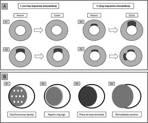A)Diagrama que muestra la interpretación de los resultados tras la TCP. Se añadirá el modificador «I−» si no se observa ningún segmento con isquemia tras la prueba de estrés (A1) o también si existe un área infartada previamente, que no muestra área de isquemia periinfarto durante la prueba de esfuerzo (A2). En cambio, si durante la prueba de estrés aparece una mayor área de isquemia peri-infarto (A3) o una nueva zona de isquemia en otro segmento independiente del área infartada (A4), se añadirá el modificador «I+». B)Tipos de placas consideradas de alto riesgo (HRP) en la nomenclatura CAD-RADS.