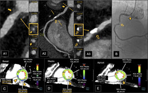 Paciente con angina de esfuerzo al que se le realiza una CTC. A) Reconstrucción planar curva de la arteria CD. B)Coronariografía de la arteria CD. C, D y E)Estudio de TCP. Se observa una estenosis del 50-69% del ostium en la arteria CD (A1, placa mixta calcificada y no calcificada, flecha coloreada) y del 70-99% (CAD-RADS 4A) en el segmento medio de la CD (A3, placa mixta, flecha vacía), hallazgos que también se corroboraron en la coronariografía posteriormente realizada (B, flechas correspondientes). Más de 8 segmentos coronarios se encontraban afectados por placas (P4). La TCP fue positiva para isquemia (I+, puntas de flecha) en los segmentos inferior e inferoseptal basales (C), segmento inferior medio (D) y segmento inferior apical (E), siendo todos ellos territorios irrigados por la ACD. Las medidas de ROI (region of interest, región de interés), medidas en unidades de Hounsfield (UH) de los segmentos isquémicos (círculos), eran significativamente más bajas que las de los segmentos bien perfundidos. El paciente fue clasificado como CAD-RADS 4A/P4/I+.