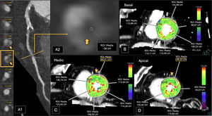 Paciente con diversos factores de riesgo cardiovascular y con múltiples calcificaciones visualizadas en TC torácica previa. A)Reconstrucción planar curva de la arteria DA, de la segunda rama diagonal. B, C y D)Estudio de TCP. La CTC muestra una placa de contenido graso (menos de −30UH, placa de alto riesgo, HRP, A1 y A2), que provoca una estenosis del 70-99% de la segunda rama diagonal de la ADA. La TCP fue positiva para isquemia (I+) en los segmentos anterior medio y anterior apical (C y D), territorios irrigados por la ADA. El paciente fue clasificado como CAD-RADS 4A/HRP/P4/I+. Los hallazgos fueron corroborados en la coronariografía convencional posteriormente realizada (no se muestra).