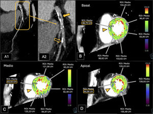 Paciente con una prueba de esfuerzo positiva por ECG. A)Reconstrucción planar curva de la arteria DA. B, C y D)Estudio de TCP. Se observa una estenosis del 50-69% en el segmento proximal (A1 y A2, placa mixta calcificada y no calcificada, flecha coloreada) y una estenosis del 70-99% en el segmento distal (A1 y A2, placa mixta, flecha vacía) de la arteria DA (CAD-RADS 4A). Más de 8 segmentos coronarios presentaban placas ateroscleróticas (P4). La TCP fue positiva para isquemia (I+) en el territorio de la ADA, específicamente en los segmentos anteroseptales basal (B) y medio (C), y en el segmento septal apical (D) (puntas de flecha y recuadros). El paciente fue clasificado como CAD-RADS 4A/P4/I+. Los hallazgos fueron corroborados en la coronariografía convencional posteriormente realizada (no se muestra).