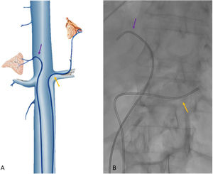 A) Esquema de la posición de los diferentes catéteres en ambas venas suprarrenales, con catéter Simmons (flecha hacia arriba) en vena suprarrenal izquierda y catéter Cobra (flecha hacia abajo) en vena suprarrenal derecha. B) Imagen obtenida de escopia donde se observan los catéteres descritos en una mujer de 68 años con hiperaldosteronismo primario. Los resultados confirmaron la presencia de una lesión en la suprarrenal derecha, basada en un índice de lateralización elevado (> 4).