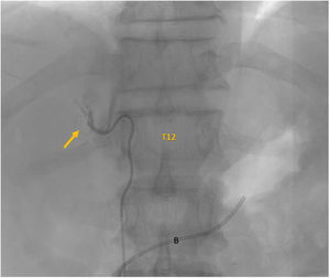 Varón de 64 años con hiperaldosteronismo primario y lesiones suprarrenales bilaterales. Imagen de la venografía de la glándula suprarrenal derecha, cuyo drenaje se encuentra en el nivel del cuerpo vertebral T12. Dicha venografía presenta un patrón no discernible. En este paciente se confirmó la realización correcta de la técnica ya que el índice de selectividad fue >5 de forma bilateral. El índice de lateralización elevado hacia la glándula suprarrenal derecha confirmó hipersecreción de la misma.