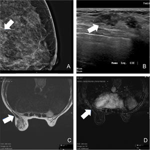 Carcinoma ductal infiltrante de mama, Luminal B HER-2 negativo, de 2,3 cm tratado con crioablación. En la mamografía magnificada realizada al diagnóstico, se ven microcalcificaciones pleomórficas localizadas en el tercio posterior de la mama (flecha en A). En la ecografía, se observa un nódulo oval, de bordes no circunscritos y orientación paralela (flecha en B). En la RM realizada 1 año tras el procedimiento, la lesión es evidente en la secuencia potenciada en T2 (flecha en C), pero no muestra realce tras la administración de contraste (flecha en D).