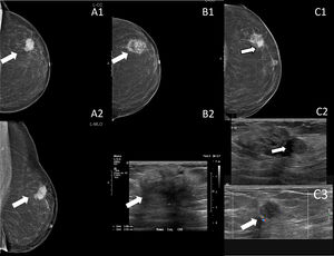 Cáncer de mama triple negativo de 3 cm diagnosticado en una mujer de 85 años que no desea cirugía (flechas en A). Se realizó crioablación, sin evidencia de recidiva en la mamografía y la ecografía de control realizadas 12 meses (flecha en B) tras el procedimiento. En el control a los 18 meses se ve una imagen densa y redondeada en la mamografía, localizada en la periferia del área de necrosis grasa (flecha en C1) y un nódulo hipoecogénico (flecha en C2) con flujo en su interior (flecha en C3). Los hallazgos están en relación con recidiva, que se comprobó con biopsia percutánea. Se realizó de nuevo tratamiento con crioablación.