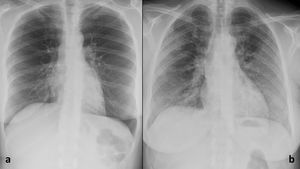 a) Radiografía posteroanterior de tórax con hallazgos normales. b)Radiografía posteroanterior de tórax con hallazgos compatibles con neumonía COVID-19 clásica.