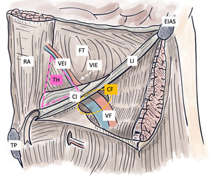 Anatomía de la región inguinal. CF: canal femoral; CI: canal inguinal; EIAS: espina iliaca anterosuperior; FT: fascia transversalis; LI: ligamento inguinal; RA: recto anterior; TH: triángulo de Hesselbach; TP: tubérculo del pubis; VEI: vasos epigástricos inferiores; VF: vasos femorales; VIE: vasos iliacos externos (referencia aproximada, quedan ocultos bajo el canal inguinal).