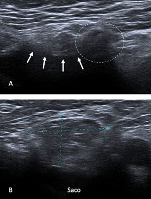 Recidiva herniaria tras hernioplastia. (A) En el margen inferomedial de la malla (flechas) se observa un saco herniario de contenido graso (círculo). (B) Medición del saco herniario. No hay signos de complicación.