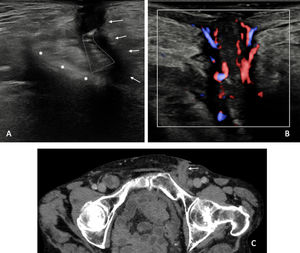 Trayecto fistuloso y migración del tapón tras hernioplastia en la región inguinal izquierda. (A) Trayecto fistuloso (flechas) en el tejido celular subcutáneo bajo la cicatriz quirúrgica que se extiende profundamente hacia la malla (asteriscos). En el seno del trayecto fistuloso, se identifica un cuerpo extraño fenestrado de morfología ondulante correspondiente al tapón inguinal migrado (líneas discontinuas). (B) Tejido hipoecogénico marcadamente vascularizado en la luz del trayecto fistuloso en probable relación con tejido de granulación. (C) TC con contraste intravenoso que demuestra la presencia de un trayecto fistuloso (flecha). Incidentalmente en la región inguinal derecha se observa una hernia inguinal de contenido intestinal medial a los vasos femorales ipsilaterales.