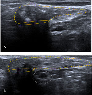 Ecografía de hernia inguinal indirecta derecha de contenido graso e intestinal, únicamente visible durante la bipedestación y con maniobras de Valsalva. (A) axial y (B) longitudinal. El cuello de la hernia (círculo) se localiza lateral a los vasos epigástricos inferiores (círculo discontinuo), en el orificio inguinal profundo, y su contenido (líneas discontinuas) se dispone en sentido transversal y anterior a los vasos epigástricos, dirigiéndose hacia medial e inferior, siguiendo el trayecto del conducto inguinal.