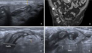 (A) y (B) Hernia de Amyand. En la región inguinal, inmediatamente subyacente al tejido celular subcutáneo (corchete), se identifica un saco herniario con contenido graso y apéndice de características normales (fechas en B), sin datos de complicación. Observe el apéndice superficializado en A. (C) y (D) Apendicitis en hernia de Amyand. El apéndice en el saco herniario (flechas blancas en D) muestra signos de apendicitis con aumento del calibre, engrosamiento de la submucosa, y cambios inflamatorios en la grasa adyacente (vasos epigástricos marcados con flecha amarilla).