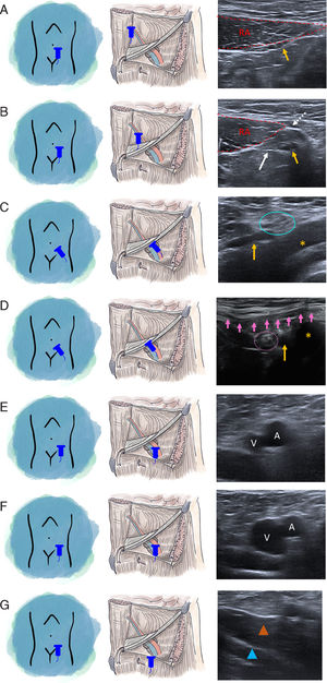 Sistemática de exploración de la región inguinal (lado izquierdo). (A) Plano axial, vasos epigástricos inferiores (flecha amarilla) en plano profundo y lateral al recto medial (líneas discontinuas rojas). (B) Plano axial, se desplaza el transductor hacia inferolateral hacia el origen de los vasos epigástricos inferiores (flecha amarilla). Fascia transversalis (flecha blanca). Fascia profunda (flecha blanca discontinua). (C) Plano oblicuo, orificio inguinal profundo (círculo azul) craneal y lateral al origen de los vasos epigástricos (flecha amarilla) en los vasos iliacos externos (asterisco amarillo). (D) Plano oblicuo, ligamento inguinal (flechas rosas) superficial al canal inguinal, en este caso conteniendo el cordón espermático (círculo discontinuo rosa). Vasos epigástricos inferiores (flecha amarilla). Vasos iliacos externos (asterisco amarillo). (E) Plano axial, triángulo de Scarpa, vasos femorales en reposo. (F) Vena femoral dilatada con las maniobras de Valsalva. (G) Plano axial, músculos pectíneo (cabeza de flecha marrón) y obturador externo (cabeza de flecha azul). A: arteria femoral; RA: recto anterior; V: vena femoral.