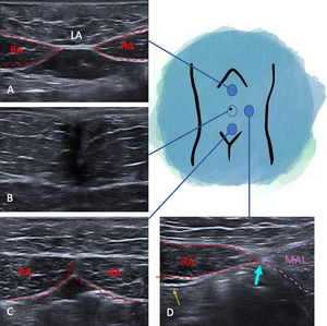Sistemática de exploración ecográfica de la pared abdominal anterior. Imágenes en plano transversal. Apariencia normal de la línea alba a nivel supraumbilical (A), umbilical (B), infraumbilical (C) y línea semilunar (D). Vasos epigástricos inferiores (flecha amarilla). Línea semilunar (flecha gruesa aguamarina). LA: línea alba; MAL: musculatura abdominal lateral (línea discontinua púrpura); RA: rectos abdominales (línea discontinua roja).