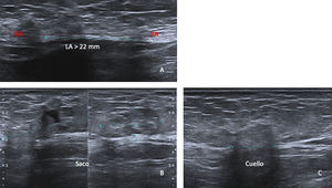 A) Diástasis de rectos anteriores a nivel supraumbilical. (B) y (C) Hernia supraumbilical de contenido graso con medidas del saco en los 3 planos (B) y del cuello (C). Los rectos anteriores muestran atrofia e infiltración grasa. LA: línea alba; RA: rectos anteriores.