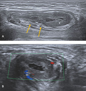 Ecografía en modo B (A) y Doppler color (B) de una hernia inguinal indirecta estrangulada que contiene un asa intestinal. (A) Engrosamiento de las paredes del asa (asterisco), engrosamiento e hiperecogenicidad de la grasa circundante (flechas). (B) Escaso flujo periférico detectable en el estudio Doppler color.