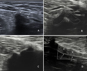 Apariencia habitual de la malla quirúrgica (A), que se presenta como una línea ecogénica ondulante con marcada sombra acústica posterior (flechas discontinuas). (B) Imagen de malla plegada sobre sí misma en «U» (líneas discontinuas). (C) Plegamiento o kinking en el margen anterior de la malla (cuadrado), con impronta sobre los tejidos suprayacentes. (D) Hernioplastia en línea media. Tejido hipoecogénico avascular de unos 5mm de espesor (asteriscos), suprayacente a la malla (flechas discontinuas) y profundo al tejido celular subcutáneo, indicativo de tejido fibrocicatricial.