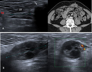 Complicaciones tras hernioplastia. Cambios posquirúrgicos de hernioplastia umbilical (A). En la ecografía de línea media se observa la malla (flecha) superficializada en el tejido celular subcutáneo, suprayacente al recto anterior izquierdo (parcialmente incluidos). En la TC se identifica una colección posquirúrgica, probable seroma (punta de flecha) en el espesor del recto anterior izquierdo que explica la superficialización de la malla, no identificada por esta técnica. (B) Hematoma en el conducto inguinal. Se observa ocupación del canal inguinal por una colección heterogénea con ensanchamiento del mismo y efecto de masa sobre el cordón espermático, que conserva su vascularización (círculo). LA: línea alba; RA: recto anterior.