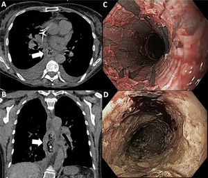 Mujer de 60 años con antecedentes de linfoma no Hodgkin y síndrome mielodisplásico secundario a leucemia mieloide aguda, refiere, en el día +15 tras TPH alogénico, dolor epigástrico y disfagia en el contexto de neutropenia febril. A-B)Se realiza una TC torácica sin contraste intravenoso que muestra engrosamiento y dilatación del esófago distal (flechas) con burbujas de aire en su pared y en la luz (estrella). La presencia de estas burbujas de aire le confieren el aspecto de «esófago negro apolillado», descrito en la necrosis esofágica aguda. C-D)La gastroscopia posterior confirma la presencia de una mucosa negra friable circunferencial y múltiples desgarros lineales.