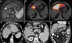 Paciente con recidiva de hepatocarcinoma en el segmento IV (A, flecha) candidato al tratamiento con radioembolización mediante esferas de ytrio-90 (Y90-RE). El SPECT con macroagregrados de albúmina muestra el correcto depósito de los mismos (B) y la PET/TC tras la administración de las microesferas, el área radiada (C). El paciente acude refiriendo dolor en hipocondrio derecho cinco días tras el procedimiento. D-F)Se realiza una TC de abdomen con contraste intravenoso, objetivándose cambios secundarios a tratamiento (D, estrella), rotura de la pared vesicular (E-F, puntas de flecha) y una pequeña colección adyacente al fundus (E-F, asteriscos). Los hallazgos son compatibles con colecistitis por irradiación y rotura por necrosis del fundus vesicular, secundarias a administración de tratamiento a través de la arteria cística.
