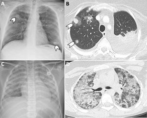 A)Varón de 52 años en el post-TPH precoz con neutropenia febril. La radiografía de tórax muestra consolidaciones pseudonodulares (punta de flecha), que sugieren infección fúngica. B)TC de tórax realizada a una paciente de 36años en el día +28 post-TPH por LLA en recaída. Se observan consolidaciones pseudonodulares con halo perilesional en vidrio deslustrado (puntas de flecha), compatibles con aspergilosis angioinvasiva. C-D)Paciente varón con neutropenia febril en el día +188 post-TPH. La radiografía de tórax (C) muestra un aumento difuso de la atenuación de ambos pulmones, algo más marcada en lóbulos superiores. La TC de tórax (D) confirma la afectación pulmonar bilateral en forma de vidrio deslustrado y consolidaciones confluentes, de predominio en lóbulos superiores. Los hallazgos radiológicos fueron sugestivos de neumonía por Pneumocystis jirovecii, confirmada en el lavado broncoalveolar posterior.