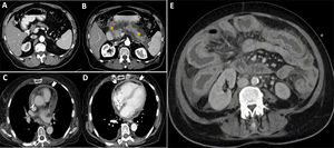 Imágenes de TC de tres pacientes con enfermedades autoinmunes secundarias a tratamiento con inmunoterapia. A-B)Pancreatitis inducida por durvalumab en un paciente con carcinoma pulmonar de células escamosas. La glándula pancreática presenta un aspecto conservado en la TC basal (A). Semanas tras el inicio del tratamiento, el paciente refiere dolor epigástrico. Se realiza una TC de abdomen, donde se observa edematización de la glándula y grasa peripancreática (B, asteriscos). C,D)Paciente con adenocarcinoma de pulmón en tratamiento con durvalumab que acudió al servicio de urgencias por dolor torácico agudo y disnea. En la TC de tórax con contraste se observa engrosamiento y realce de las hojas pericárdicas (puntas de flecha), sugestivo de pericarditis. E)Engrosamiento difuso de la pared del intestino delgado y grueso, con hiperemia mucosa y edema submucoso, en un paciente con cáncer de pulmón no microcítico en tratamiento con atezolizumab (enterocolitis inmunomediada).