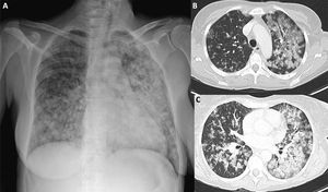 Mujer de 36 años con LLA-B refractaria. Refiere disnea e hipoxia 3días tras el inicio de la terapia con CAR-T. A)Se solicita una radiografía de tórax urgente (anteroposterior), que muestra infiltrados alveolares asimétricos, confluentes, de predominio izquierdo. B,C)Imágenes axiales en ventana de parénquima pulmonar de la TC torácica realizada ese mismo día que confirma la presencia de infiltrados confluentes en lóbulos superiores, con áreas de mayor consolidación en lóbulos inferiores. La afectación, bilateral, predomina en el pulmón izquierdo. Los hallazgos sugieren edema pulmonar no cardiogénico, en el contexto de un síndrome de liberación de citoquinas (CRS).