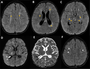 Niño de 3 años con LLA-B con sospecha de toxicidad neurológica por terapia CAR-T. Se solicita una RM cerebral. A-C)En secuencias T2-FLAIR se observa afectación generalizada de la sustancia blanca, ambos tálamos y ganglios basales sugestivo de edema cerebral difuso (asteriscos). D-E)Algunas de estas áreas muestran hiperintensidad en secuencias de difusión (D) con restricción de la difusión en el mapa de coeficiente de difusión aparente (ADC, E) que sugiere restricción a la difusión de la alteración de señal subcortical parietal derecha (flechas). F)En secuencias T2 FLAIR post-contraste se observa también realce leptomeníngeo en surcos (puntas de flecha), coincidiendo con áreas de hiperintensidad de señal. Los hallazgos son sugestivos de ICANS (ASTCT-4).