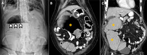 Varón de 77 años que acude al servicio de urgencias refiriendo estreñimiento y distensión abdominal de cuatro días de evolución. A)La radiografía de abdomen muestra escasa aireación intestinal, salvo un nivel hidroaéreo en vacío derecho (puntas de flecha) que parece corresponder el ángulo hepático del colon dilatado. No se objetiva distensión de asas de delgado ni neumoperitoneo. B-C)Para descartar causa obstructiva se recomienda completar con una TC abdominal que confirma la presencia de una zona de estenosis concéntrica en «corazón de manzana» en el colon transverso (flecha), sugestiva de neoformación primaria (probable adenocarcinoma) con dilatación retrógrada de ángulo hepático y colon ascendente (asteriscos). Se programa colostomía derivativa, que confirma el cuadro obstructivo secundario a neoplasia en colon transverso.