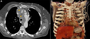 Mujer de 67 años con cáncer microcítico de tumor en tratamiento con quimioterapia clásica (cisplatino y etopósido). Acude a urgencias refiriendo tos seca persistente y edema cérvico-torácico. Ante la sospecha de un síndrome de vena cava superior se solicita una TC torácica con contraste (A), que muestra conglomerados adenopáticos mediastínicos (A, asteriscos) que provocan compresión de la vena cava superior, con marcada reducción de su calibre. Se observa también afilamiento del tronco innominado izquierdo (A, punta de flecha). La presencia de circulación colateral en mediastino anterior y pared torácica anterior (flechas blancas), con especial dilatación de las venas mamarias internas, confirma la repercusión hemodinámica de la obstrucción. B)Reconstrucción cinemática del tórax en coronal que resalta la circulación colateral prominente secundaria a síndrome de vena cava superior.