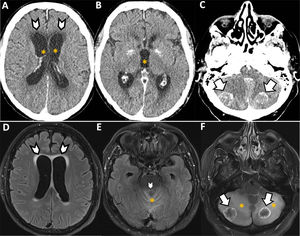 Varón de 68 años, cardiópata, con adenocarcinoma de sigma metastásico (hepático, peritoneal y pulmonar) en tratamiento con quimioterápicos clásicos y antiangiogénicos (bevacizumab). Desde hace unos meses se encuentra en fibrilación auricular paroxística con alteraciones asociadas de la repolarización. Acude a urgencias por primer episodio de cefalea de inicio súbito. Se solicita una TC cerebral para descartar afectación tumoral cerebral y/o sangrado. Reconstrucciones multiplanares axiales (A-C) realizadas tras la administración intravenosa de contraste muestran como nuevos hallazgos dos lesiones ocupantes de espacio en ambos lóbulos cerebelosos (flechas), con realce anular de contraste, que condicionan obliteración prácticamente completa del cuarto ventrículo con hidrocefalia supratentorial (asteriscos) y edema transependimario especialmente a nivel frontal (puntas de flecha). Se realiza, de manera programada, una RM cerebral (D-F, imágenes T2 FLAIR en plano axial), que confirma la presencia de edema transependimario periventricular (D, puntas de flecha), obstrucción del cuarto ventrículo (E, punta de flecha) y lesiones metastásicas con captación anular de contraste en ambos hemisferios cerebelosos (F, flechas). Se observa también extenso edema perilesional en vermis (E, asterisco) y hemisferios cerebelosos (F, asteriscos).