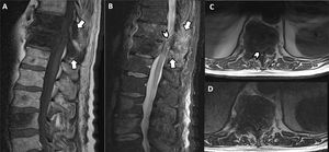 Paciente de 62 años con cáncer de próstata metastásico y debilidad en extremidades inferiores de nueva aparición. Se solicita una RM de columna urgente. (A,B)Las imágenes T1 y T2 STIR en sagital muestran afectación metastásica en T11 y T12, con rotura del muro posterior y afectación de elementos posteriores (flechas). Las imágenes T1 y T2 en axial (C-D) confirman la extensión de la enfermedad al espacio epidural anterior. En todas las imágenes se aprecia reducción significativa de la amplitud del canal vertebral y compresión en dicho nivel del cordón medular (puntas de flecha).