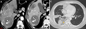 (A,B) Paciente con melanoma metastásico que acude a urgencias refiriendo dolor abdominal agudo en el hipocondrio derecho. Se realiza una TC abdominal, donde se observa sangrado activo (flechas) de una metástasis hepática en la fase arterial (A), que aumenta confirmado en la fase portal (B). C)Varón de 42años con sarcoma metastásico que acude a urgencias por varios episodios de hemoptisis desde hace 12horas. Se realiza una TC de tórax, que revela opacidades en vidrio deslustrado (asterisco) alrededor de las metástasis pulmonares, sugestivas de corresponder con focos de hemorragia alveolar.