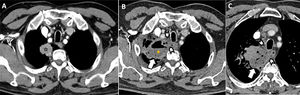 Varón de 62 años en estudio por sospecha de neoformación broncopulmonar primara en lóbulo superior derecho (A, estrella). Acude a urgencias cinco días tras la realización de biopsia de la lesión mediante ecoendoscopia alta, refiriendo fiebre termometrada de 38°C, tos y dolor torácico leve. B,C)Se solicita una TC torácica, que muestra incremento de la extensión de la lesión localizada en ápice pulmonar derecho (flechas), que presenta burbujas de gas en su interior y un nivel hidroaéreo (asterisco). Los hallazgos son compatibles con sobreinfección (abscesificación) de la lesión pulmonar localizada en ápice derecho. Se observa, además, aumento de la atenuación de la grasa en mediastino, especialmente en la región paraesofágica derecha (puntas de flecha), que sugiere inflamación regional (mediastinitis).