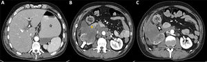 Varón de 48 años con cáncer renal metastásico que acude a urgencias por dolor intenso (VAS 9/10) en flanco derecho. La TC abdominopélvica realizada tras la administración intravenosa de contraste muestra distensión de la cámara gástrica (A, estrella) secundaria a estenosis de la segunda porción duodenal por infiltración tumoral (B, asterisco). Además de la obstrucción mecánica se observa fistulización de la masa renal con el colon ascendente (C, punta de flecha).