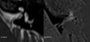 Ejemplo de secuencia 3D-REAL-IR axial obtenida 4h tras la administración de una dosis única de gadoterato de meglumina (Dotarem®) por vía intravenosa, para la valoración de HE, en un paciente alérgico al contraste de gadobutrol. Se muestra como alternativa a la utilización de los contrastes comúnmente utilizados. En este paciente no se observaron signos de HE.