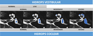 Representación esquemática sobre secuencia T2 de cisternografía de los grados de HE vestibular y coclear, sombreado en azul el componente endolinfático. Se representan los 3 grados de HE coclear y las escalas de 3 y 4 grados de HE vestibular. Nótese cómo el grado normal de la escala de 3 grados vestibular se escinde en normal y leve en la escala de 4 grados (en el grado normal, el sáculo es más pequeño que el utrículo, en el grado leve el sáculo es igual o mayor que el utrículo, pero todavía no confluyen).