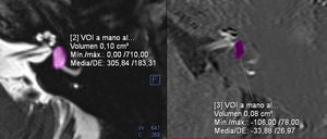Cálculo de la razón o ratio endolinfática (REL) vestibular. Corresponde al porcentaje del volumen total del vestíbulo que es ocupado por la endolinfa. Un volumen endolinfático de 0,08cm3 en un vestíbulo de 0,1cm3 corresponde a un REL del 80%. Grado moderado según la clasificación cualitativa.